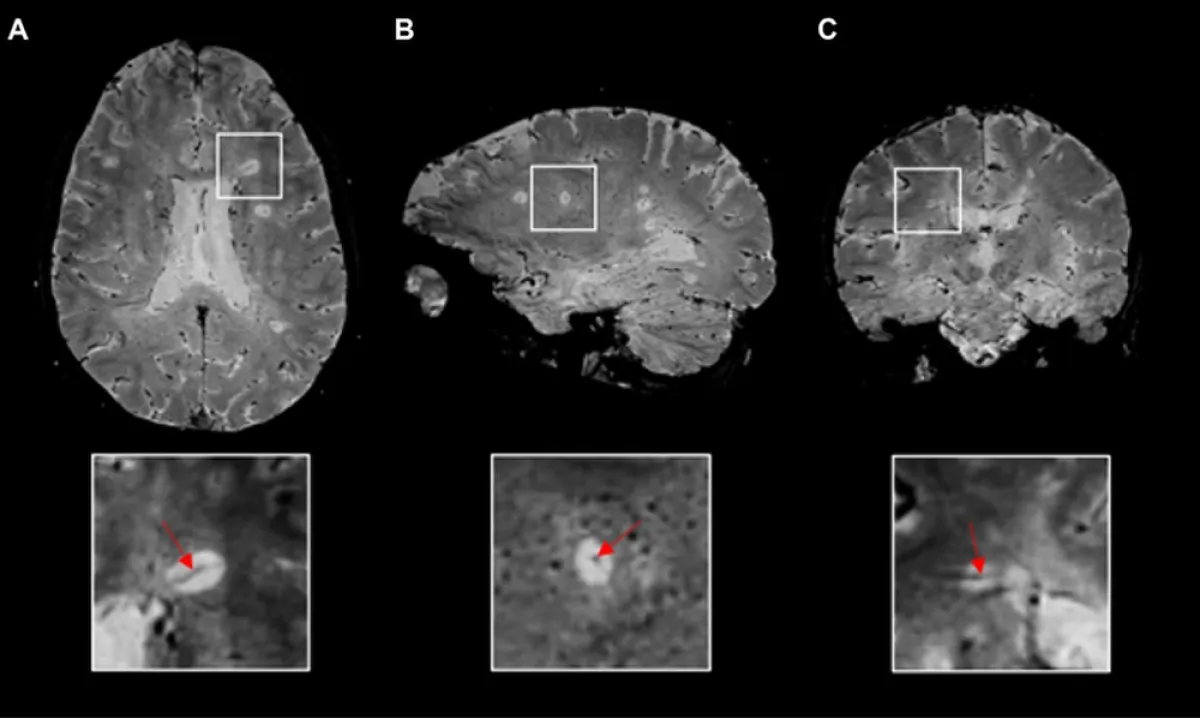 Клиническое МРТ изображение Echo Planar Imaging EPI