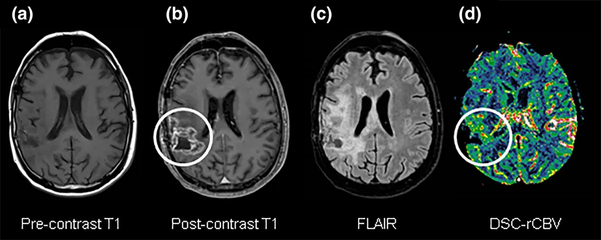 Клиническое МРТ изображение DSC-MRI