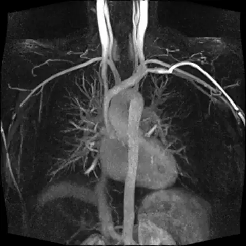 MRI CE-MRA