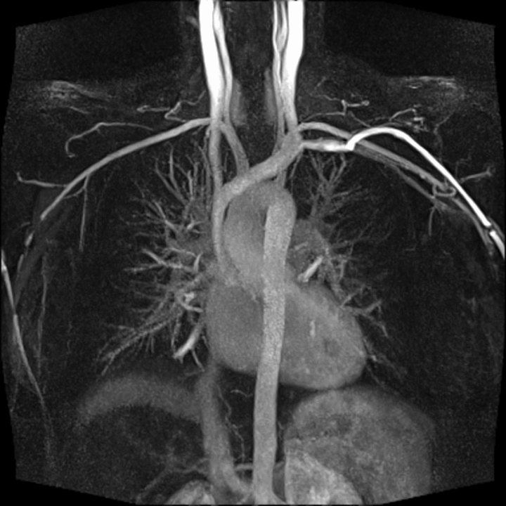 MRI CE-MRA