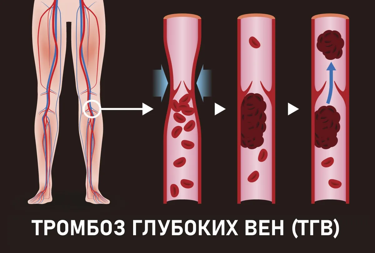 Тромбоз глубоких вен (ТГВ)