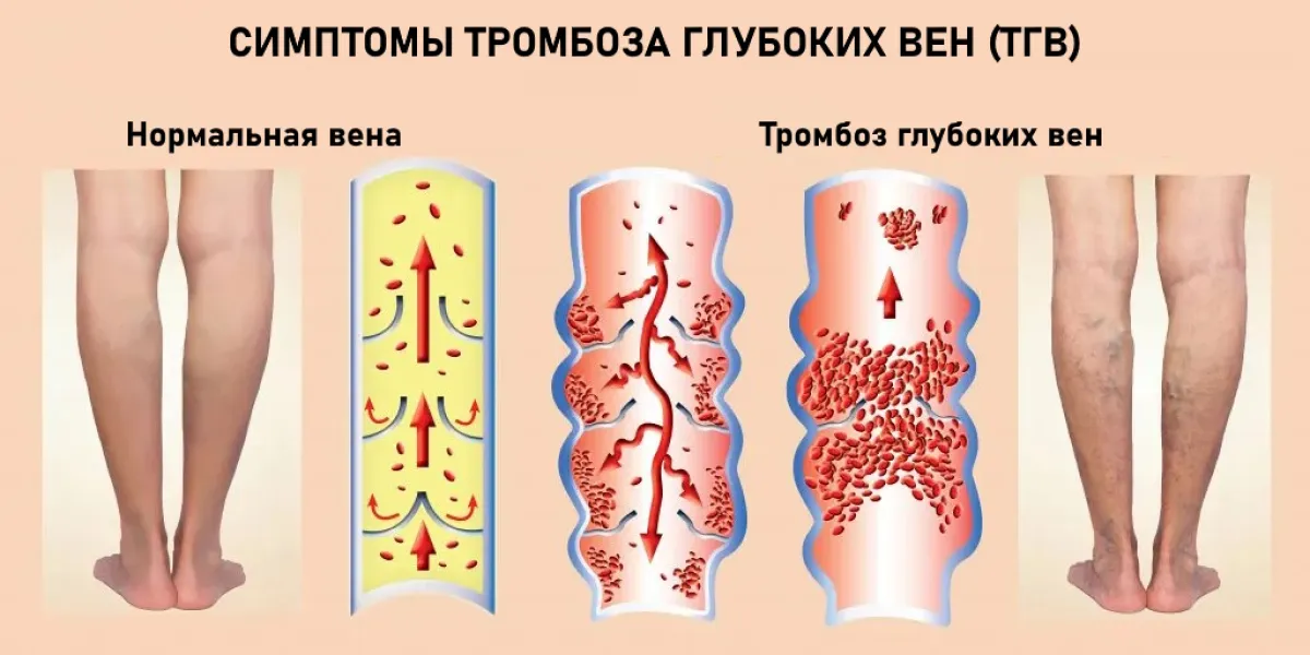 Симптомы тромбоза глубоких вен (ТГВ)
