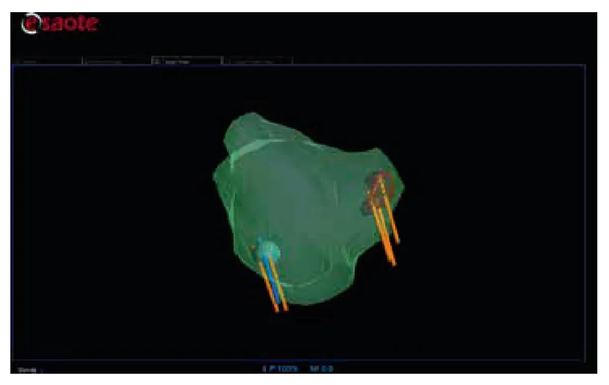 3D-изображение предстательной железы с отображением точек взятия образцов ткани