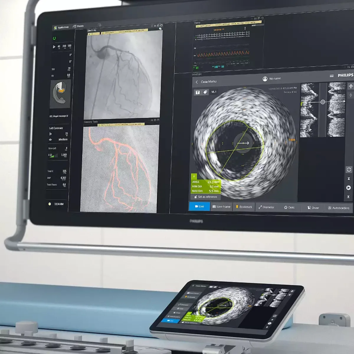 ВСУЗИ Philips IntraSight