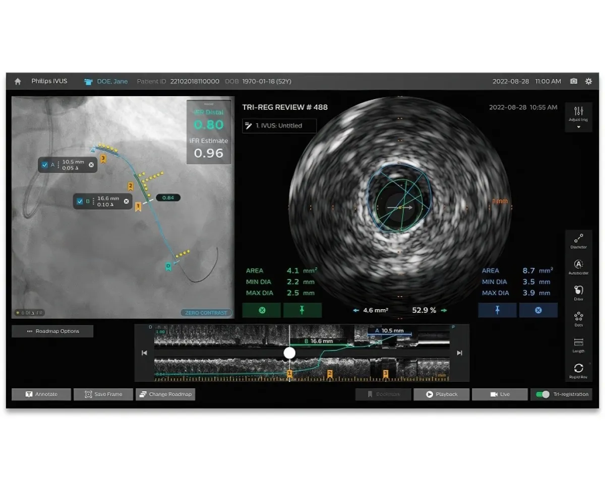 Ко-регистрация в Philips IntraSight