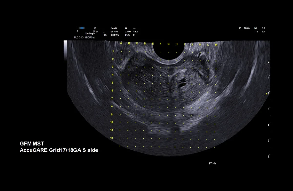 Esaote Prostate Biopsy Stepper License