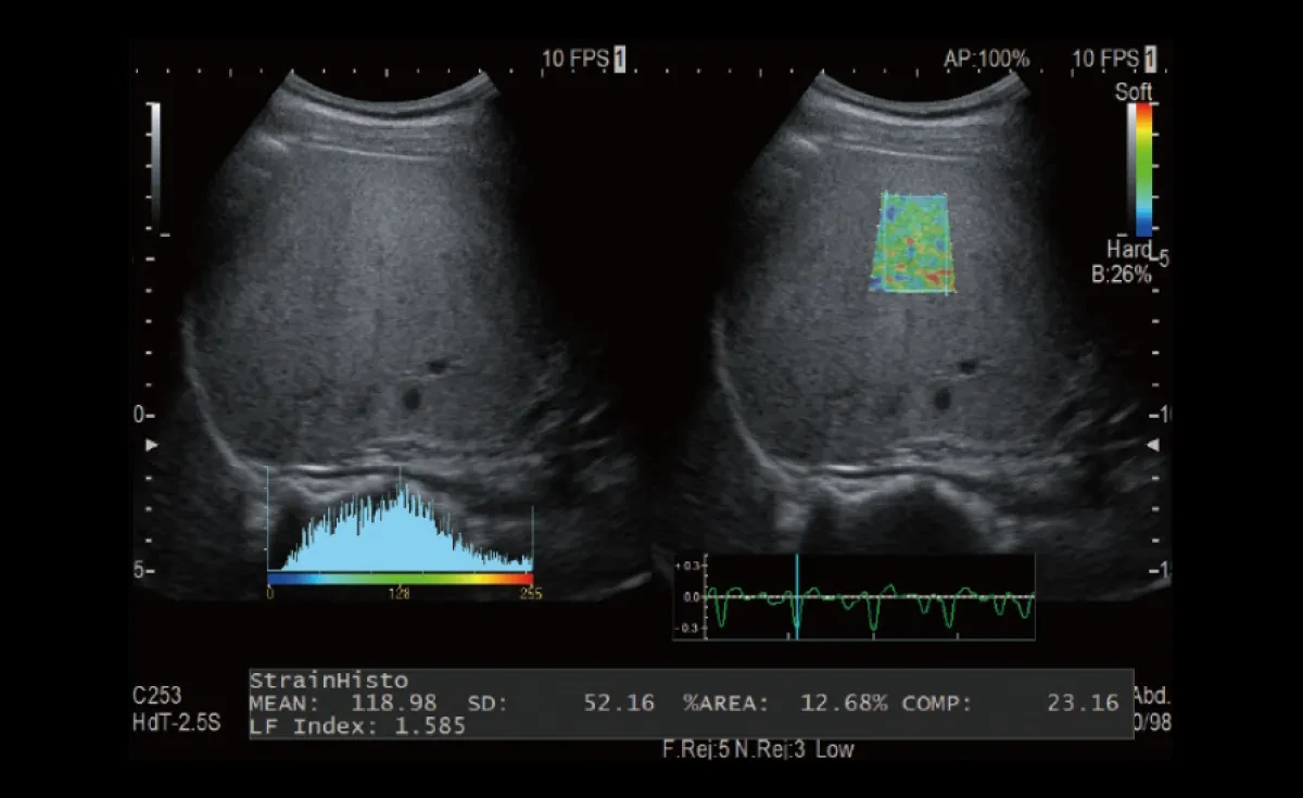 Real-time Tissue Elastography в Fujifilm Arietta 65