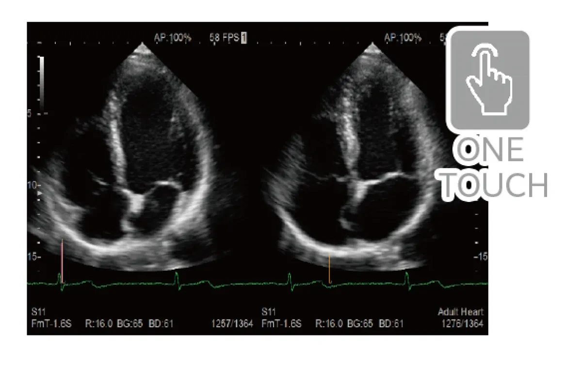 Automated ED/ES Detection