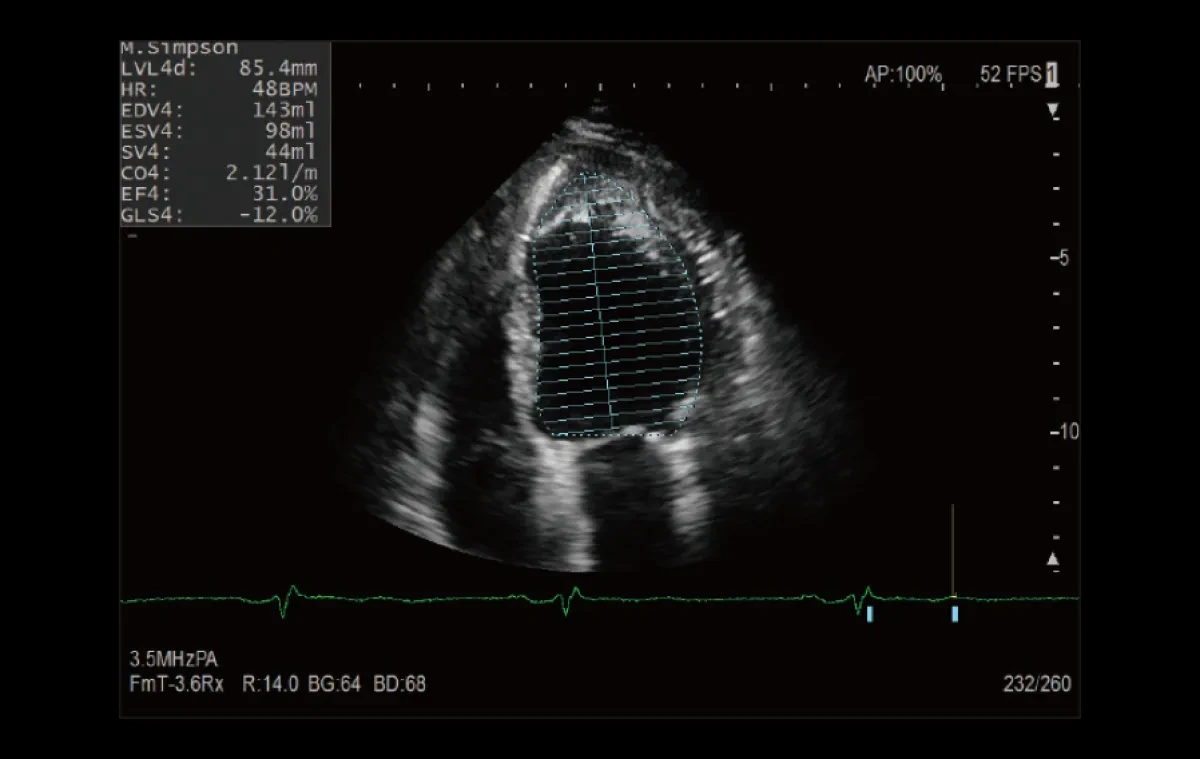 Global Longitudinal Strain в аппарате УЗИ Fujifilm Arietta 65