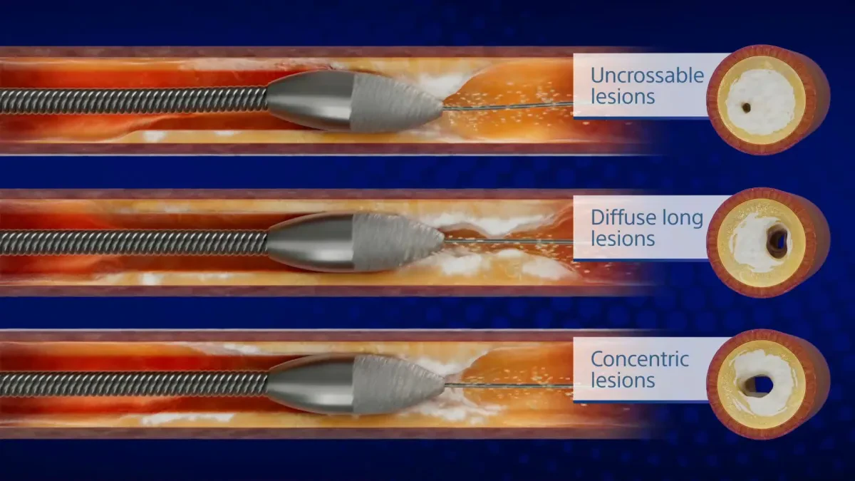Атерэктомия Boston Scientific ROTAPRO