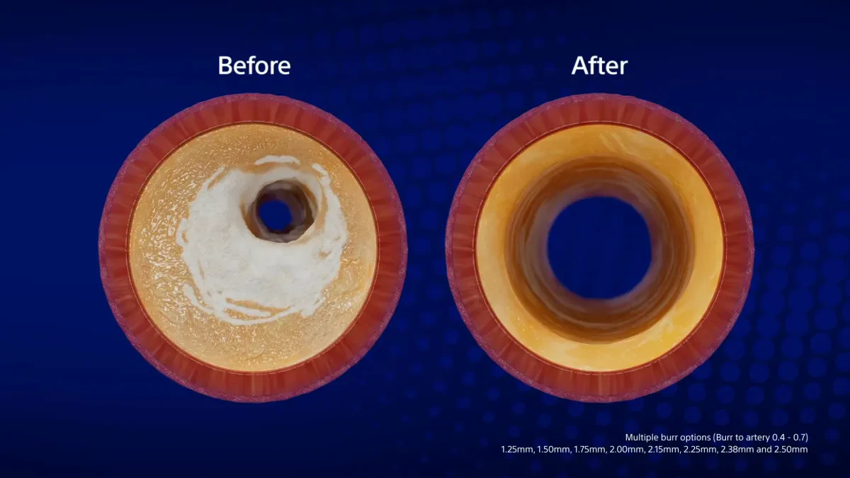 модификация сосудистой стенки с помощью Boston Scientific ROTAPRO 