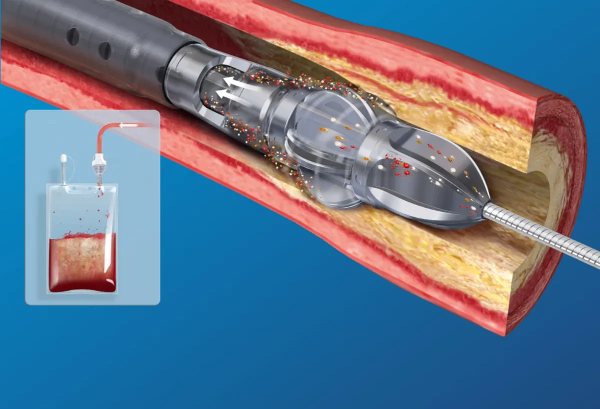 Система активной непрерывной аспирации в Boston Scientific JETSTREAM