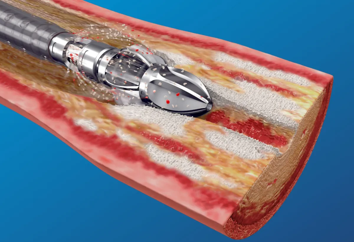 Фронтальные режущие лезвия в Boston Scientific JETSTREAM
