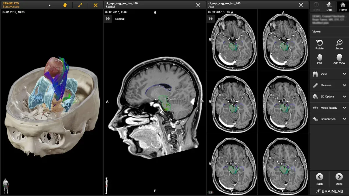 Краниальное планирование и предоперационная подготовка в Brainlab Elements