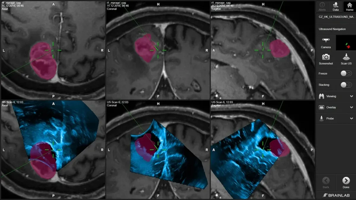 Интраоперационная ультразвуковая навигация в Brainlab Curve