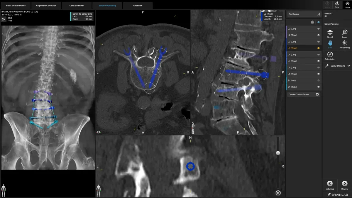 Планирование операций на позвоночнике с Spine Planning