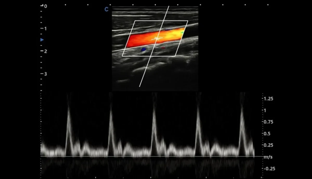 Технология Intelligent Doppler