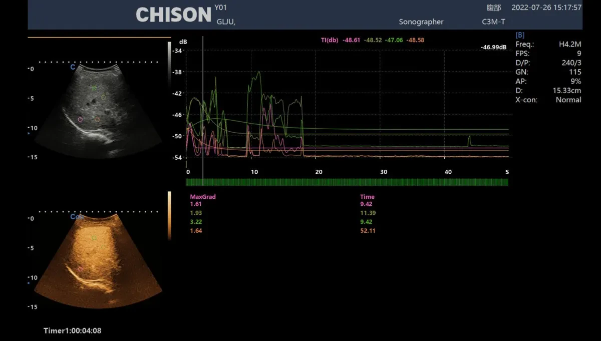 Технология SonoContrast в Chison Xbit 80